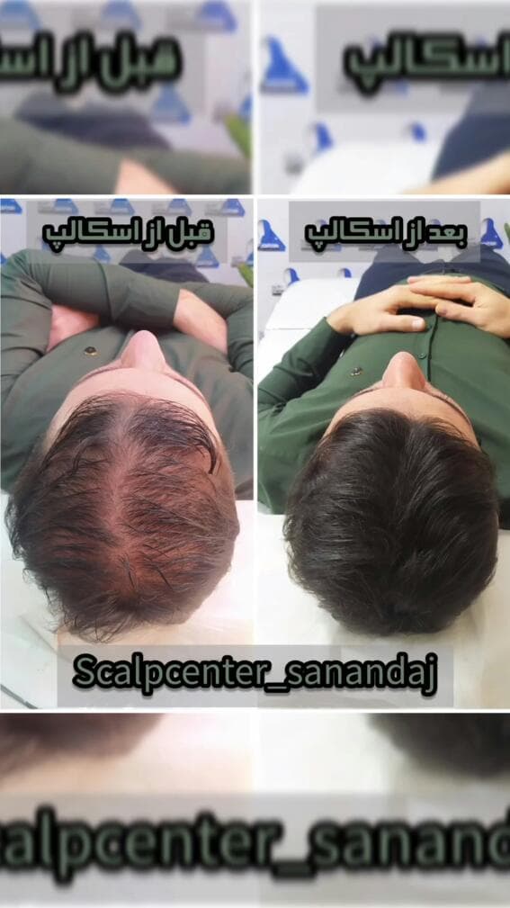 خدمات میکرواسکالپ و اسکالپ و میکروبلیدینگ اسکالپ سنتر در سنندج کردستان