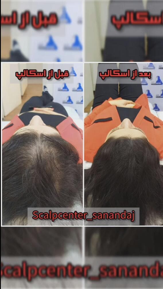 خدمات میکرواسکالپ و اسکالپ و میکروبلیدینگ اسکالپ سنتر در سنندج کردستان