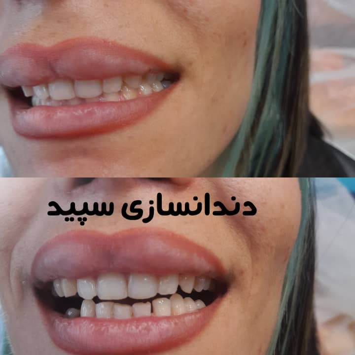 دندانسازی سپید در لاهیجان