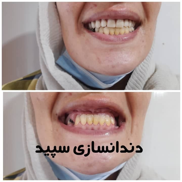 دندانسازی سپید در لاهیجان