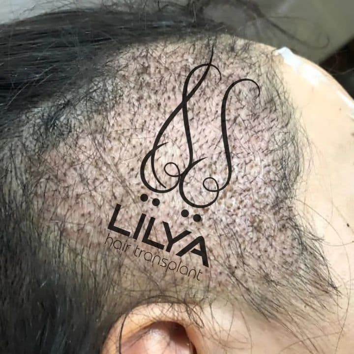 مرکز تخصصی آموزش و کاشت مو لیلیا در ارومیه