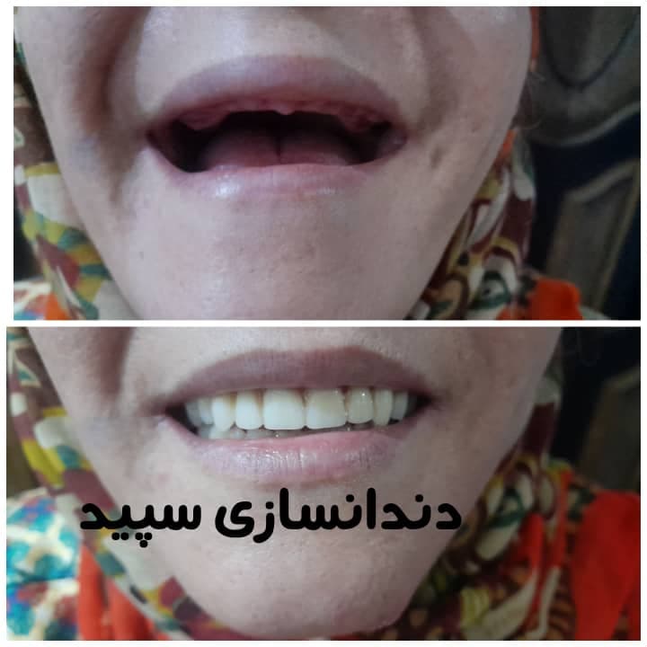 دندانسازی سپید در لاهیجان