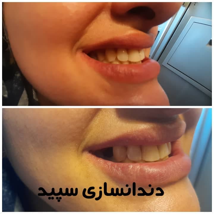 دندانسازی سپید در لاهیجان