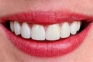 خدمات دندانسازی متحرک و ثابت مهدی حسین زاده در ارومیه