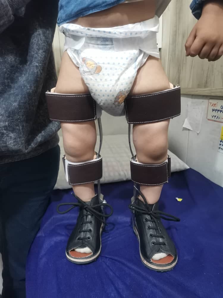 طراحی و ساخت کفی طبی و پروتز ارتوپدی فنی توان بخش در شیراز