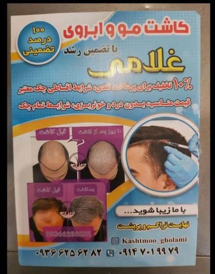 کاشت مو غلامی تبریز