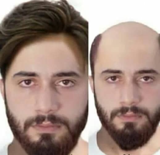 ترمیم پروتز مو احمدی در تهران