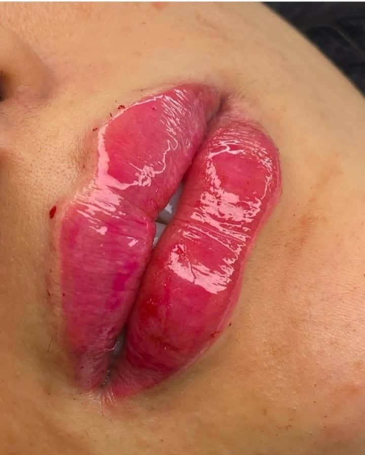 کلینیک تخصصی ژل و بوتاکس لب روسی در اسلامشهر