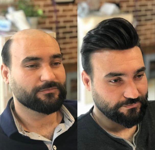 خدمات پروتز مو و میکروبلیدینگ با استایل مردانه محمد افلاک در قزوین