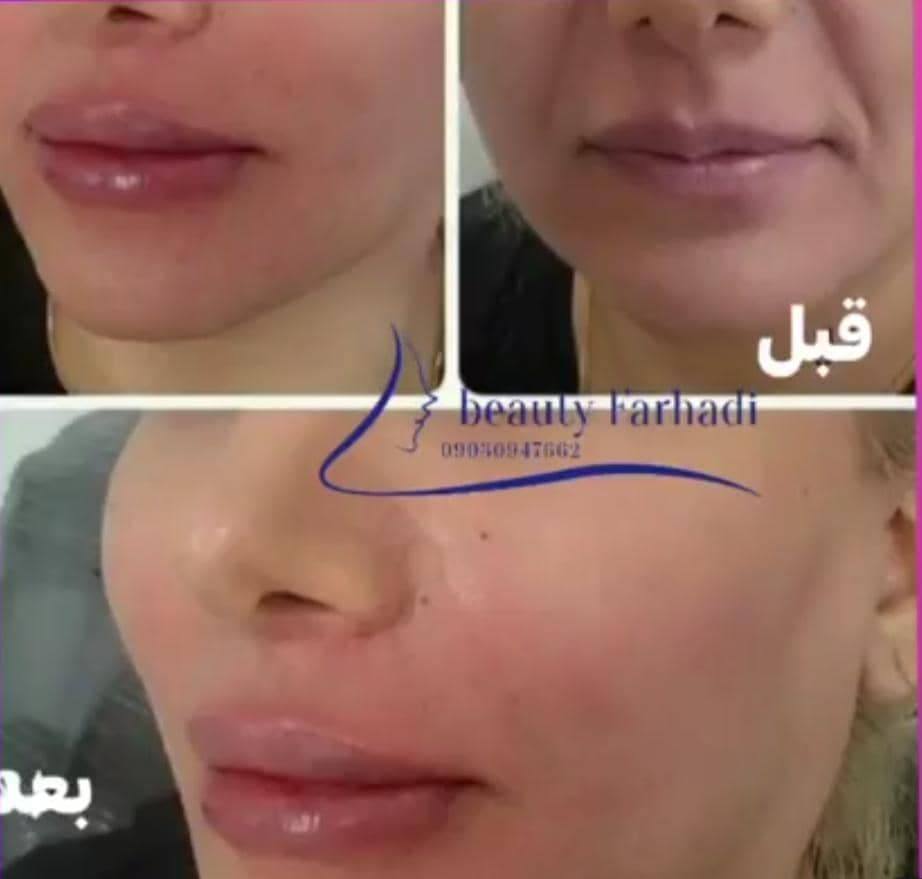 تزریق ژل و بوتاکس فرهادی در لرستان
