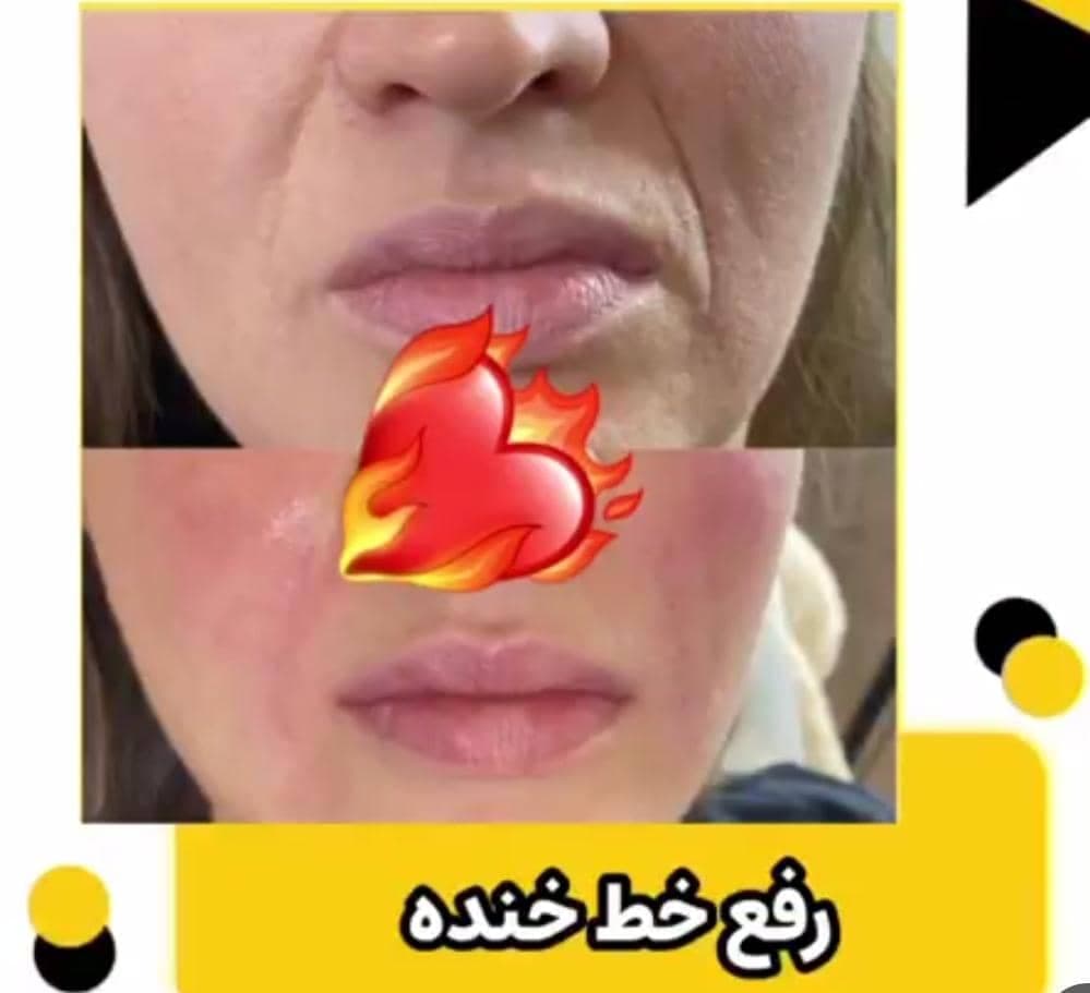 تزریق ژل و بوتاکس فرهادی در لرستان