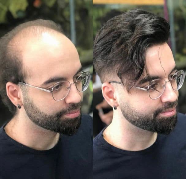 خدمات پروتز مو و میکروبلیدینگ با استایل مردانه محمد افلاک در قزوین