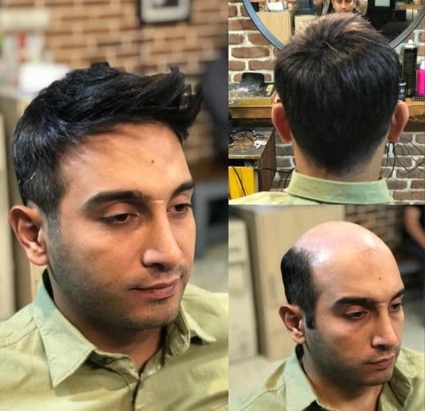 خدمات پروتز مو و میکروبلیدینگ با استایل مردانه محمد افلاک در قزوین