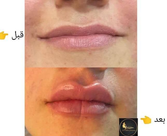 خدمات ژل و بوتاکس آمنه در آبادان