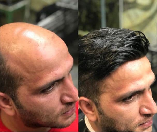 خدمات پروتز مو و میکروبلیدینگ با استایل مردانه محمد افلاک در قزوین