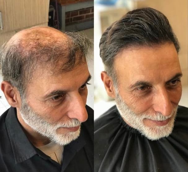 خدمات پروتز مو و میکروبلیدینگ با استایل مردانه محمد افلاک در قزوین