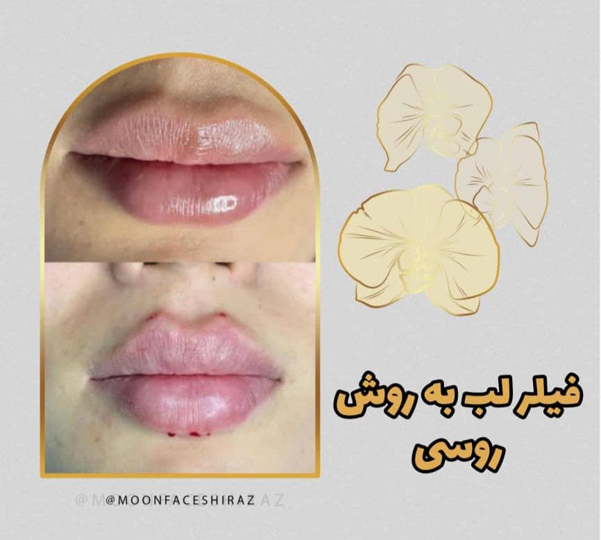 مرکز زیبایی پوست و لیزر و فیشال مون فیس در شیراز