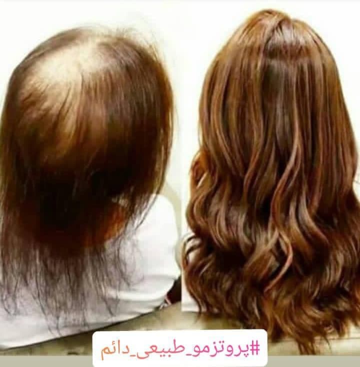 مرکز تخصصی پروتز مو طبیعی مسترکات در کیش
