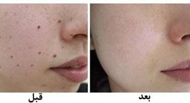 خدمات درمان زگیل تناسلی و ترمیم ‌و لیزر و هایفو درسا در خرم آباد