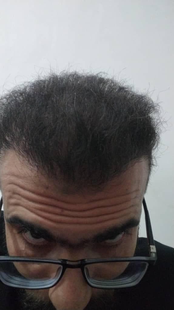 کاشت مو و ابرو هخامنش در شیراز