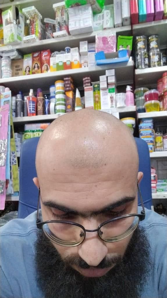 کاشت مو و ابرو هخامنش در شیراز