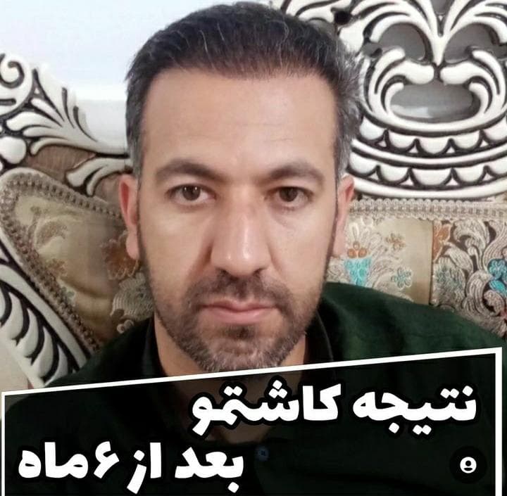 کاشت مو و ابرو مریم شیروانی در شیراز