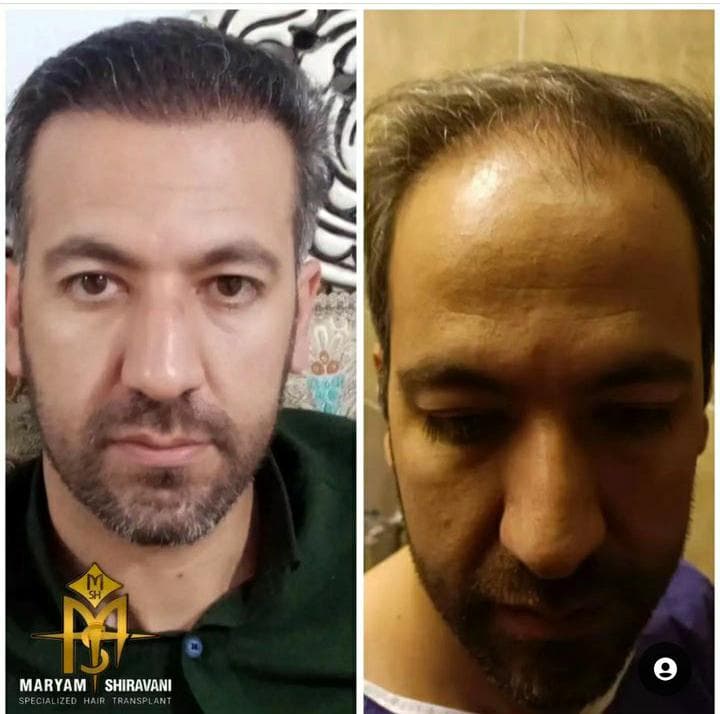 کاشت مو و ابرو مریم شیروانی در شیراز