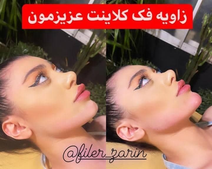 کلینیک زیبایی فیلر زرین در ساری