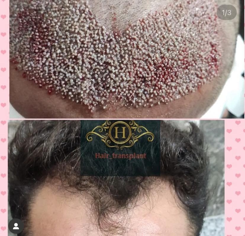 کلینیک کاشت مو و ابرو سقز کاشت در سقز