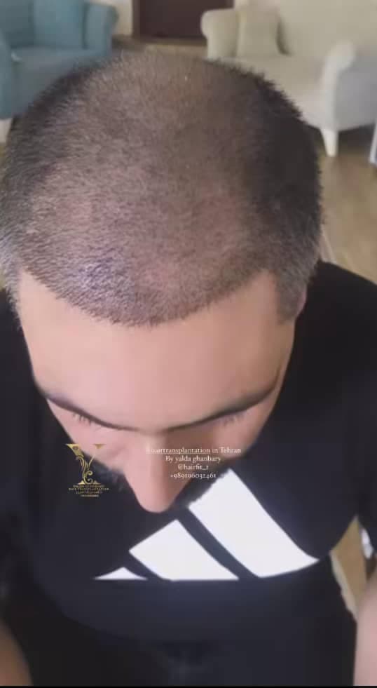 کاشت مو و ابرو و ریش یلدا قنبری در سعادت آباد تهران