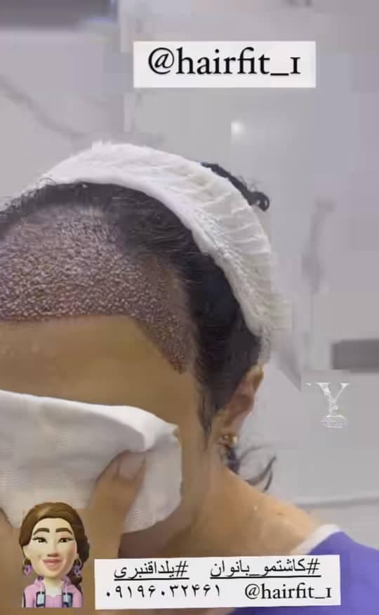 کاشت مو و ابرو و ریش یلدا قنبری در سعادت آباد تهران