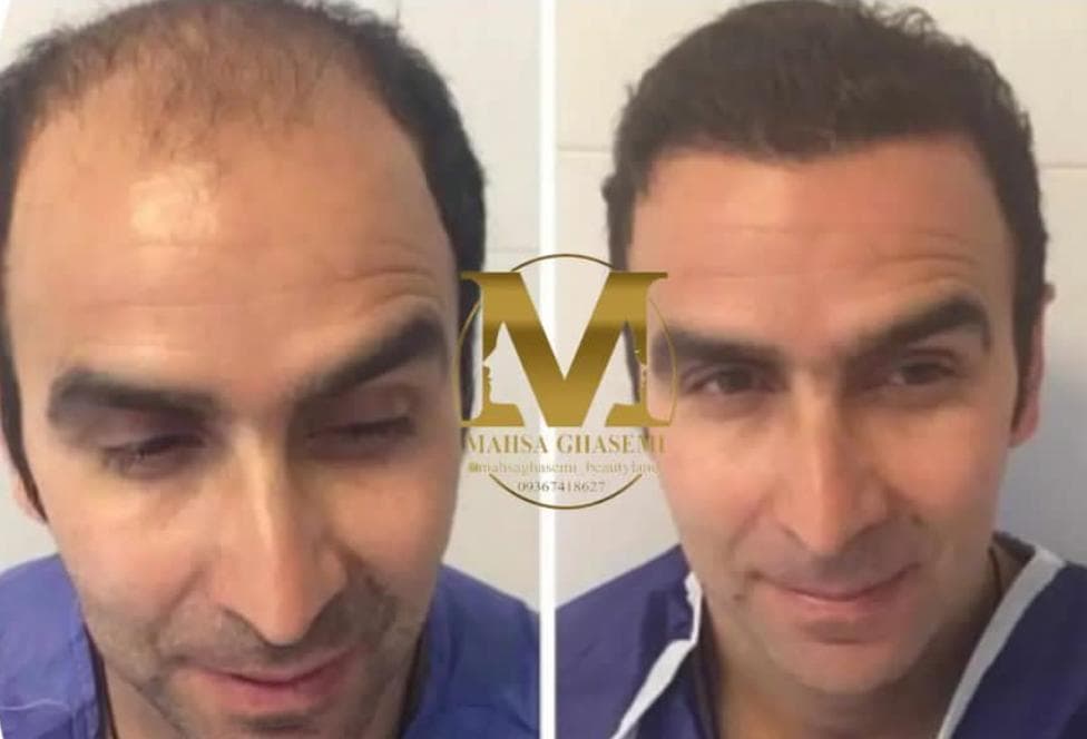 خدمات کاشت مو مهسا قاسمی در شیراز