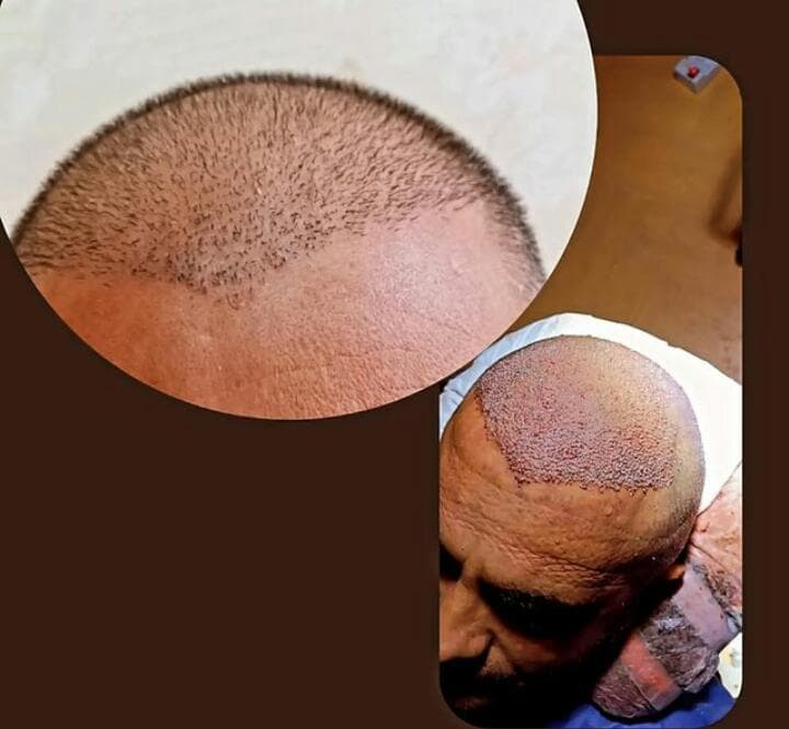 خدمات کاشت مو و ابرو کلینیک مورویان در مهاباد آذربایجان غربی