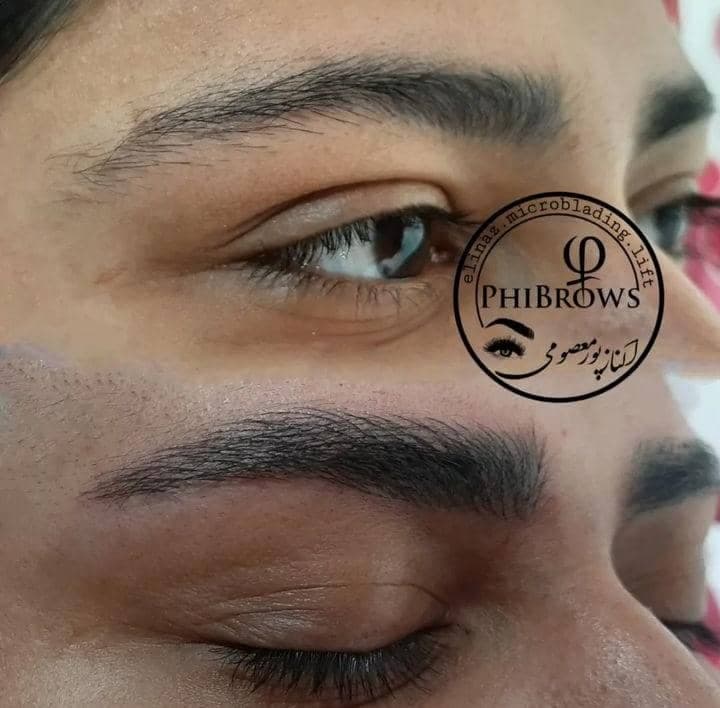 فیبروز و میکروبلیدینگ الیناز در سیرجان