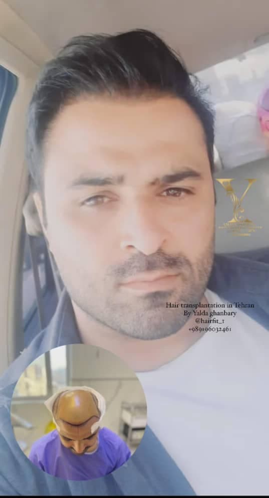 کاشت مو و ابرو و ریش یلدا قنبری در سعادت آباد تهران