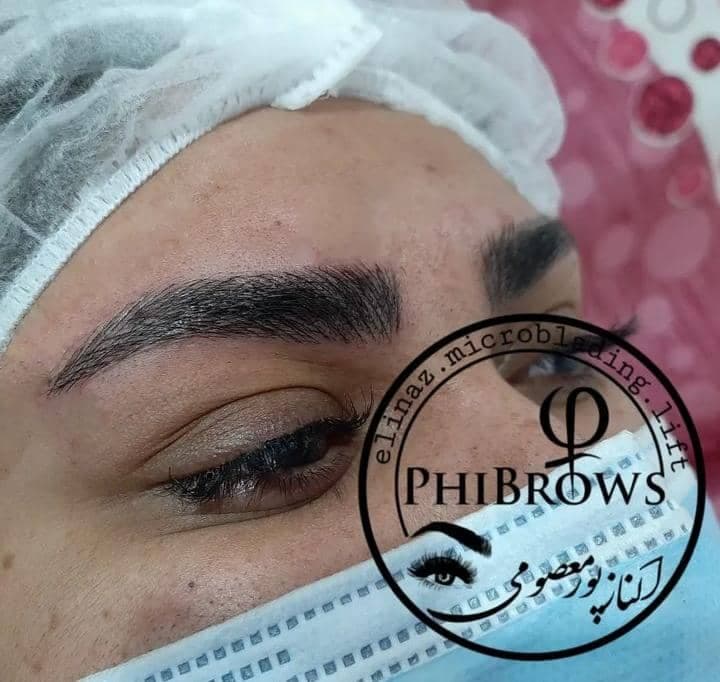 فیبروز و میکروبلیدینگ الیناز در سیرجان