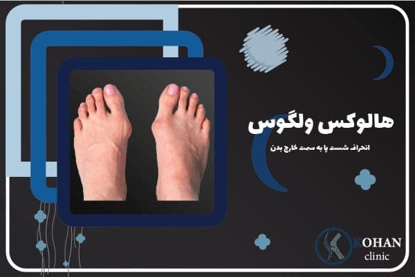 درمان صافی و درد کف پا زانوی پرانتزی قوز کمر کلینیک کهن در تهران
