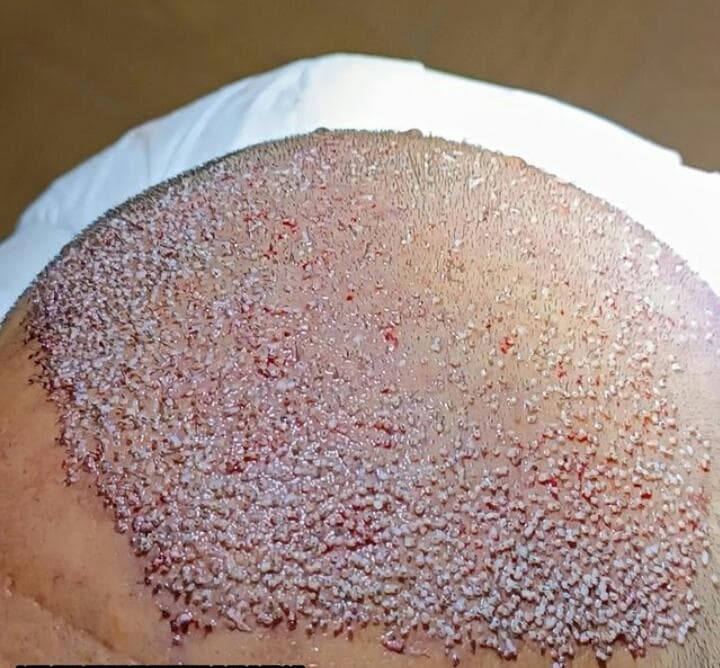 خدمات کاشت مو و ابرو کلینیک مورویان در مهاباد آذربایجان غربی