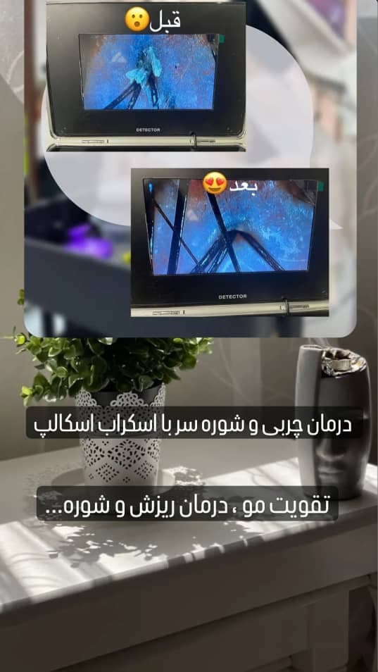 مرکز تخصصی میکرواسکالپ و درمان کم پشتی مو نازنین لحیم چی در بابل مازندران