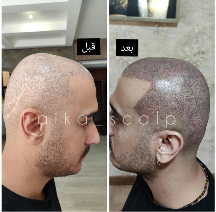 مرکز تخصصی میکرواسکالپ و اسکالپ سر و اسکالپ اسپرت هایکا در شیراز