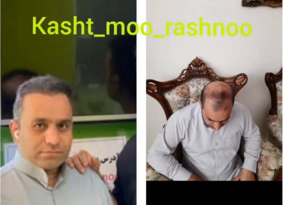 کاشت مو رشنو در کرمانشاه