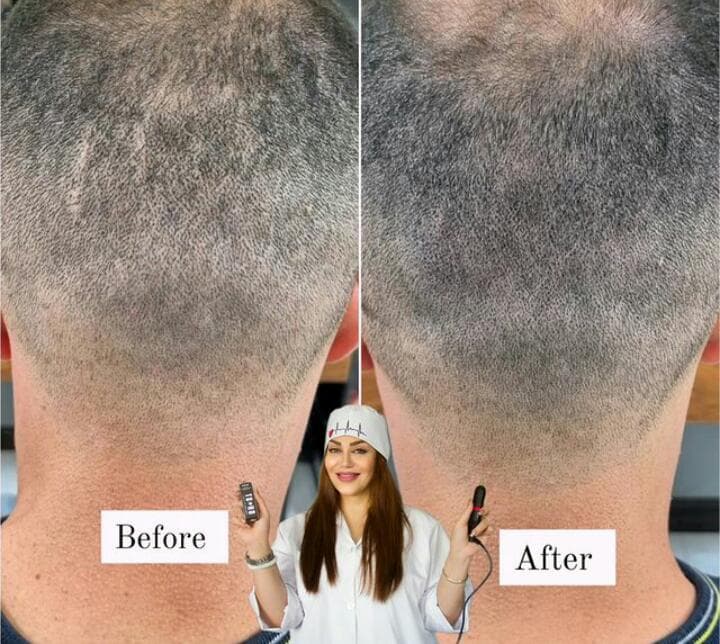 مرکز تخصصی میکرواسکالپ و درمان کم پشتی مو نازنین لحیم چی در بابل مازندران