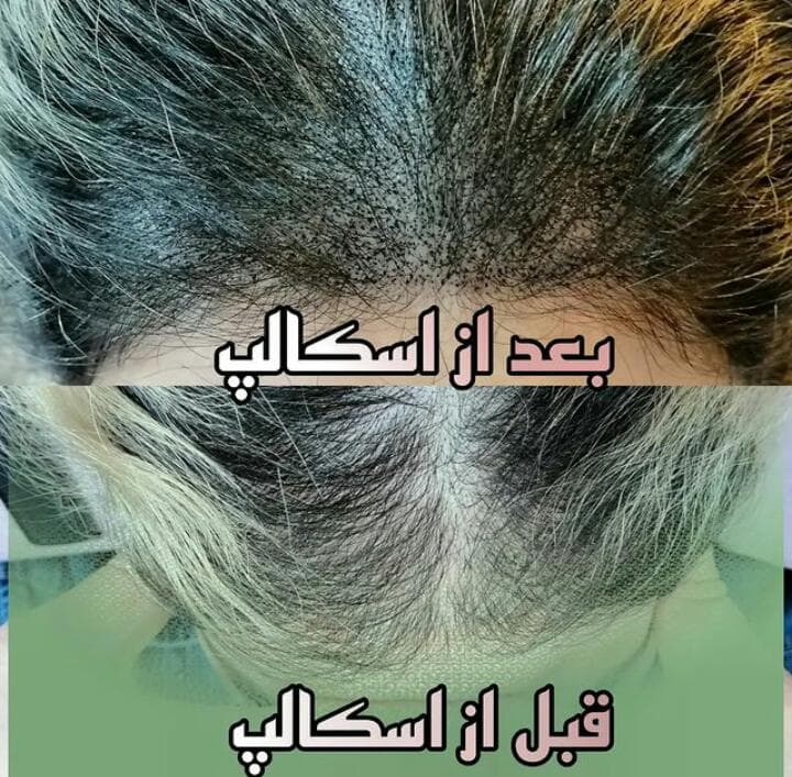 مرکز تخصصی میکرواسکالپ و درمان کم پشتی مو نازنین لحیم چی در بابل مازندران