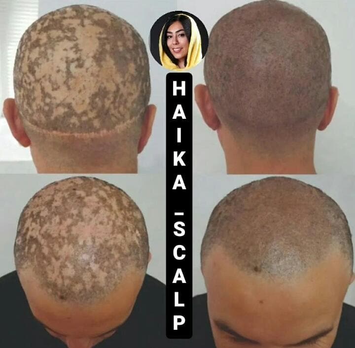 مرکز تخصصی میکرواسکالپ و اسکالپ سر و اسکالپ اسپرت هایکا در شیراز