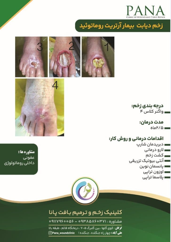 کلینیک زخم و ترمیم بافت پانا در گرگان گلستان