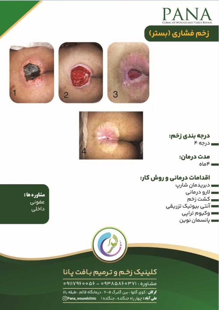 کلینیک زخم و ترمیم بافت پانا در گرگان گلستان