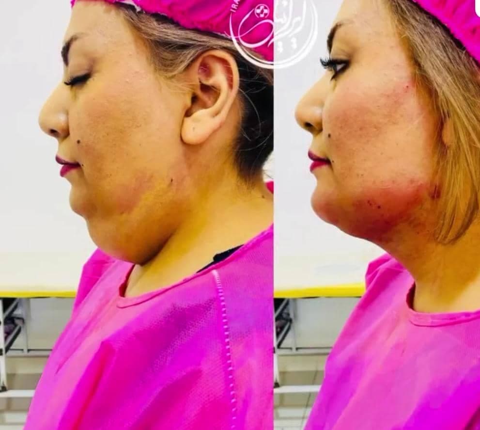 تزریق ژل و بوتاکس دکتر مهسا فتحی در ارومیه