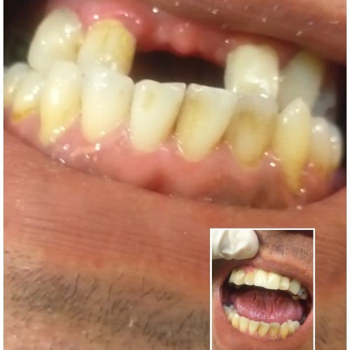 ساخت تک و چند دندان فلیپر دندانسازی دریا در جردن تهران