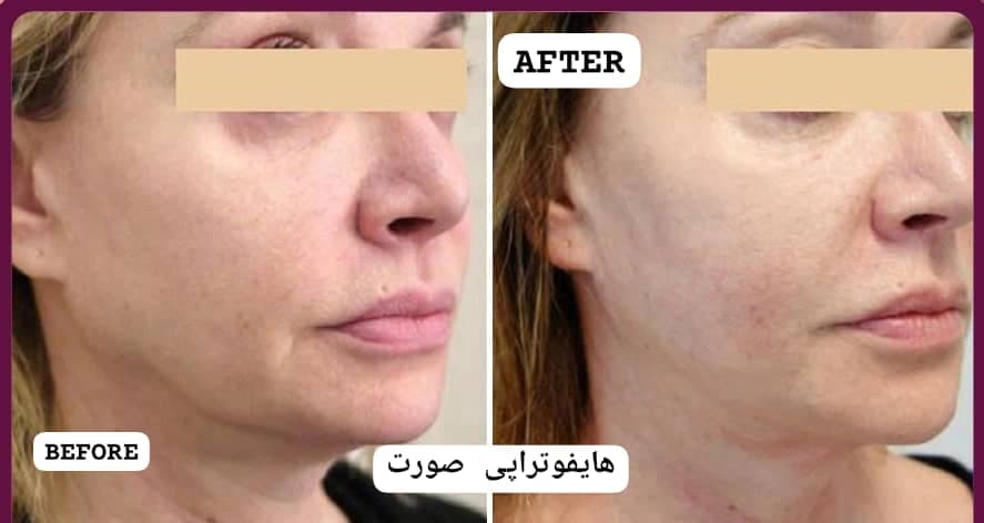 خدمات تخصصی پاکسازی پوست هایفوتراپی مزوتراپی مو و صورت فروزان خواجوی در اهواز