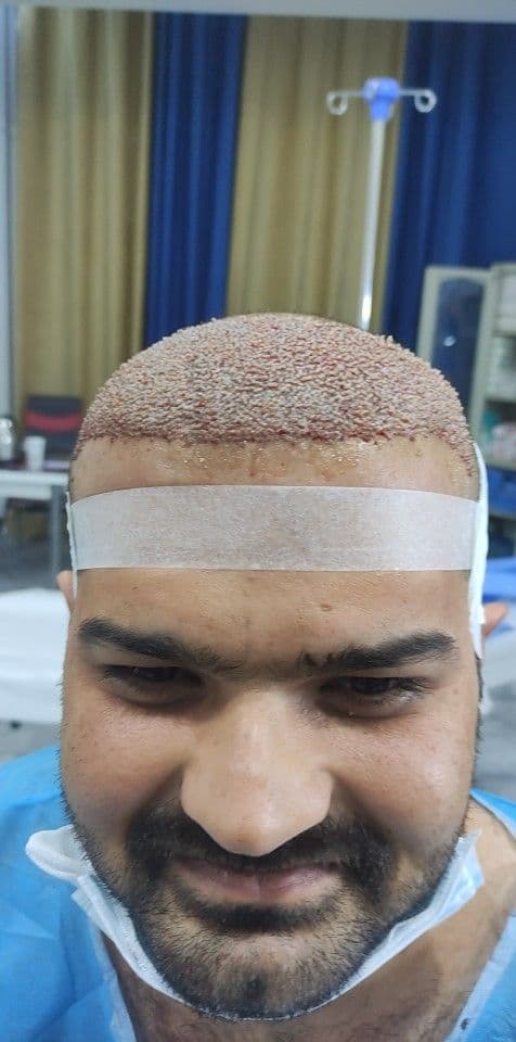 کاشت مو و ابرو دکتر مژگان کشاورز در شیراز